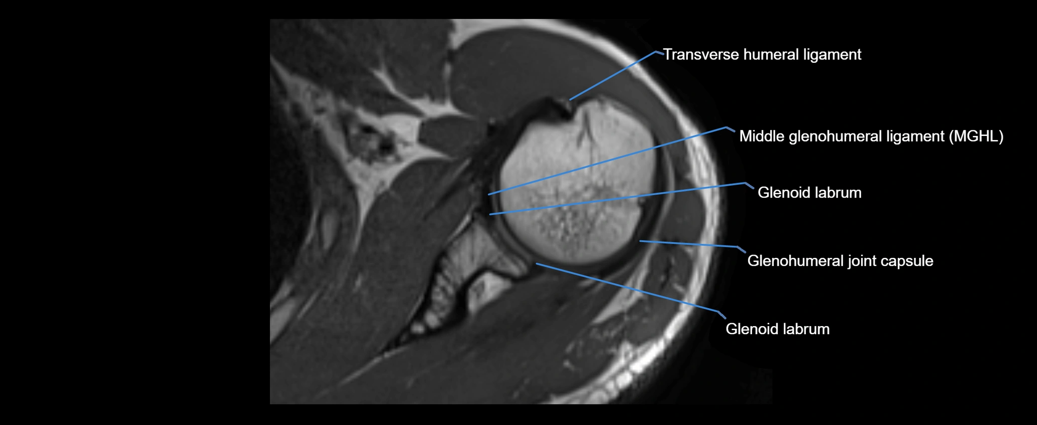 shoulder ligaments axial 3d 3t mri image-img-00005-00059.webp